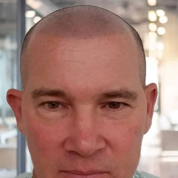 <strong>How Scalp Micropigmetation Can Help Female Hair Loss Problems</strong> 3 After