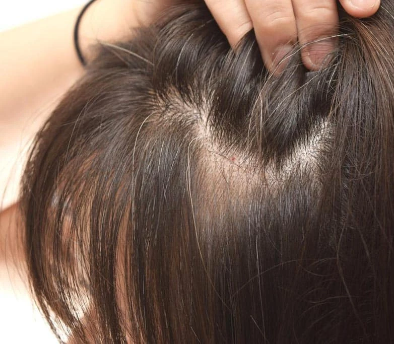 thin hair for women that can help with smp