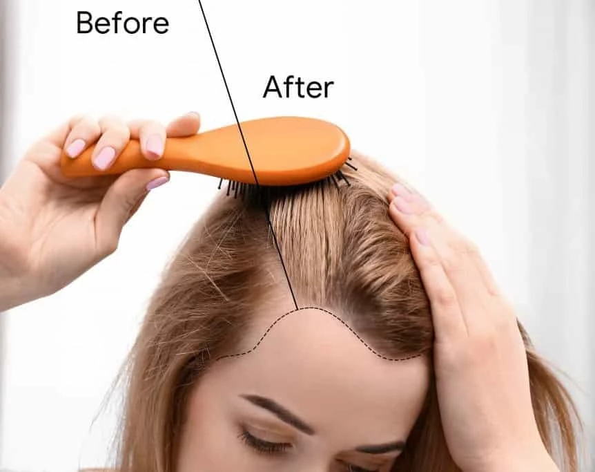 smp female before after SCALPS