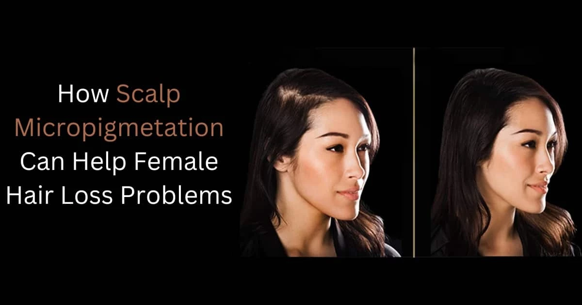 <strong>How Scalp Micropigmetation Can Help Female Hair Loss Problems</strong> 1 blog 2 SCALPS