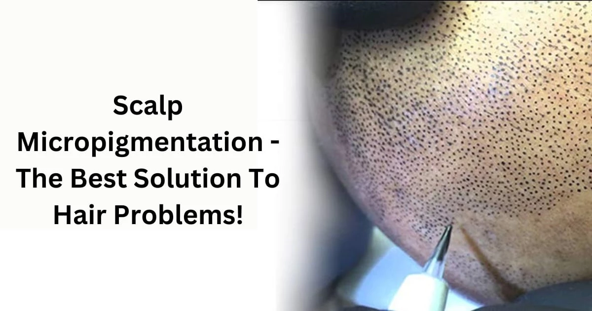 Scalp Micropigmentation - The Best Solution To Hair Problems! 1 blog3 SCALPS