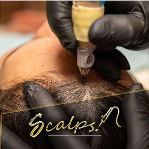 BLOG | Scalp Micropigmentation Centers 19 unnamed SCALPS