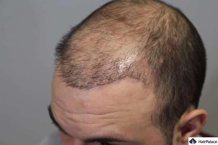 Scalp micropigmentation vs. hair transplants: a comparison 2 hair transplant gone wrong SCALPS