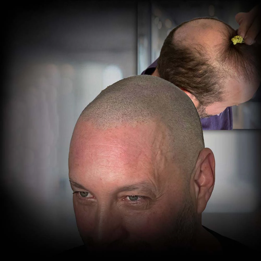 Find The Best Scalp Micropigmentation Near Me 3 scalp micropigmentation before and after with beautiful result - WEBSITE